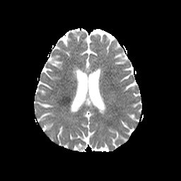 MRI Brain ADC map